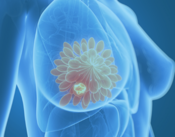 Breast Cancer Location Breast Cancer Location