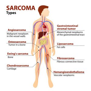 Sarcoma cancer in leg symptoms