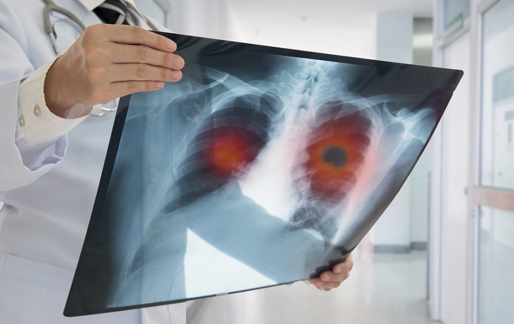Doctor examines a chest x-ray