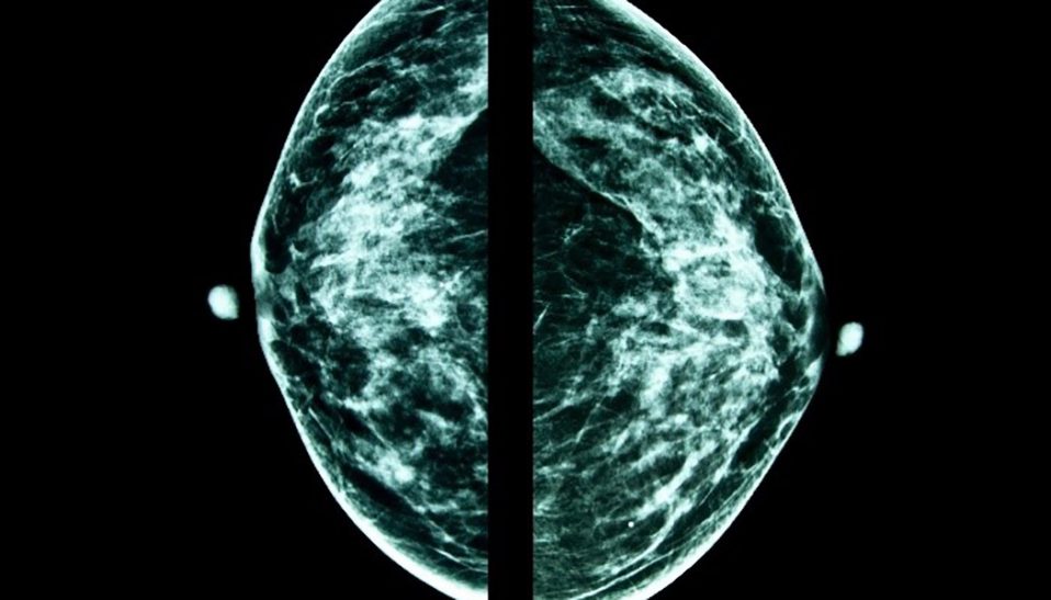 Mammogram image