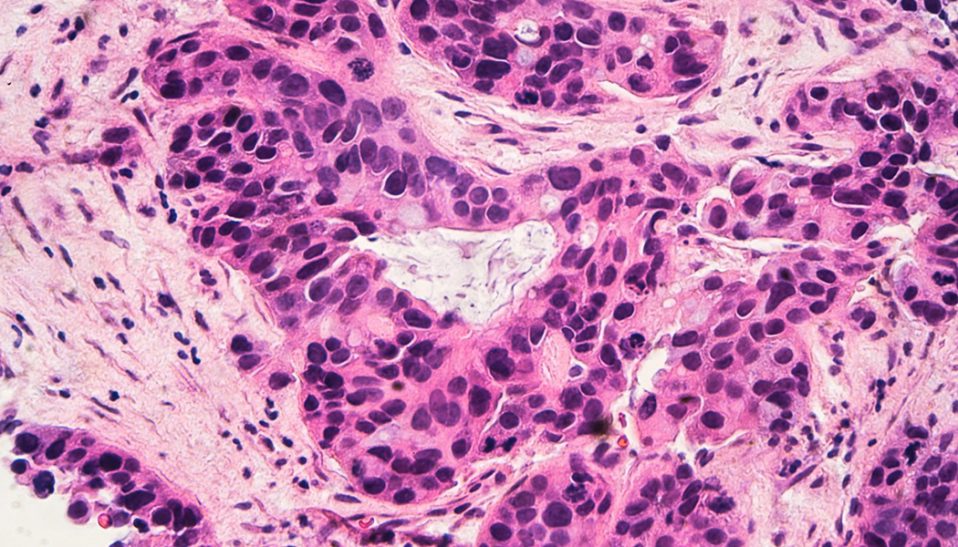 Breast Cancer Linked to Bone Marrow Cells