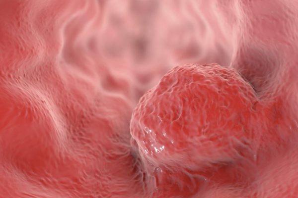 Esophageal Cancer