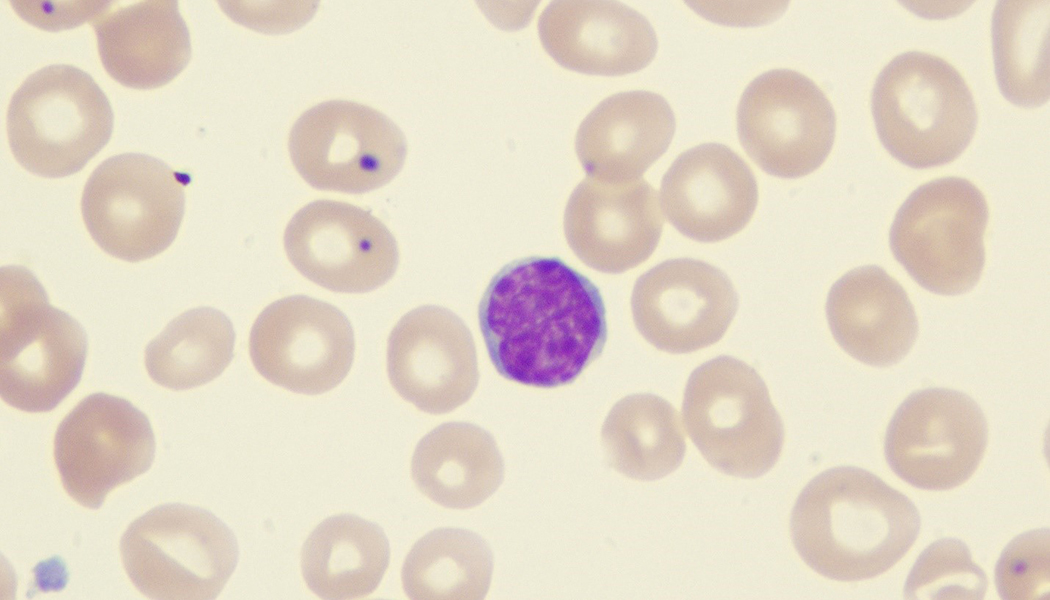 Hodgkin S Vs Non Hodgkin S Lymphoma What S The Difference Nfcr