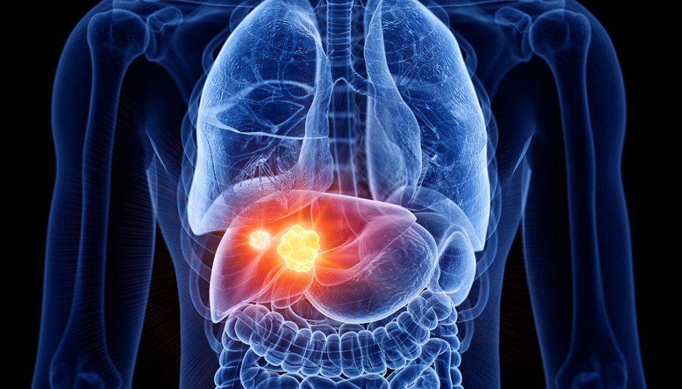 3D Liver Cancer Rendering