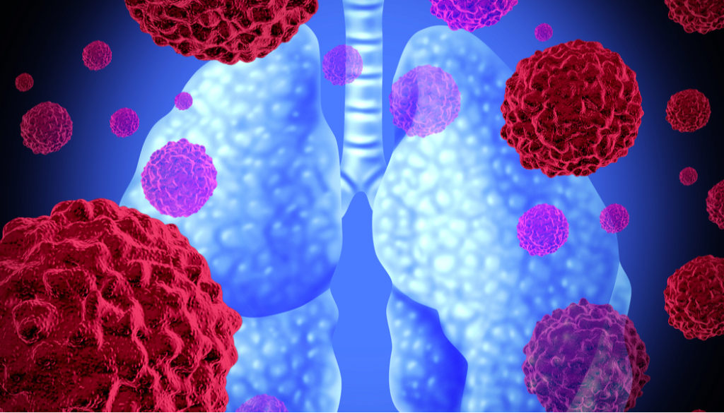 Lung Cancer | Cancer Types - National Foundation for Cancer Research