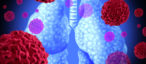 SCLC vs NSCLC