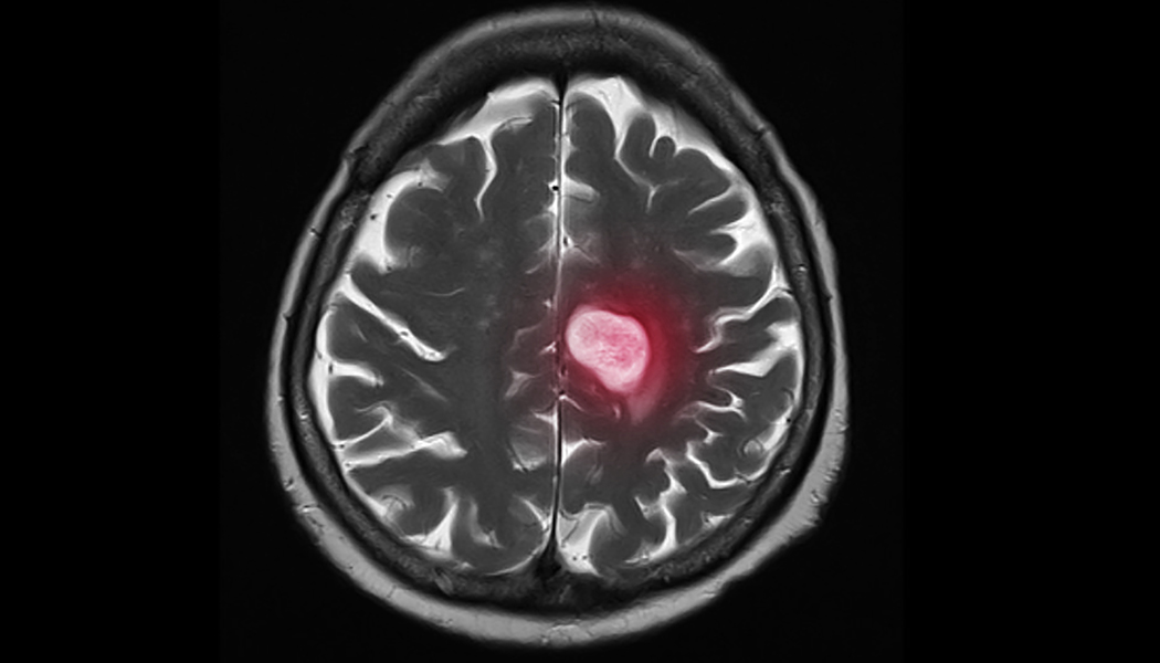 metastasis breast cancer brain cancer