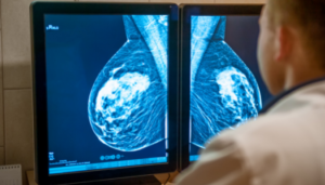 Mammogram Cancer Screening