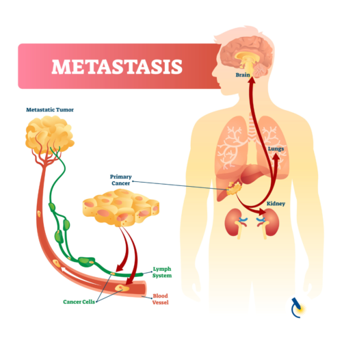 Metastasis Infographic