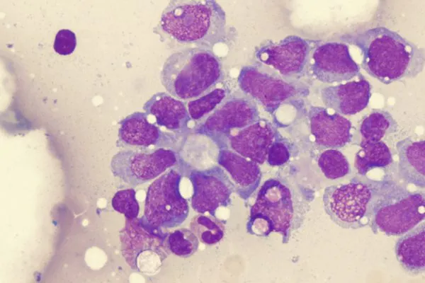 Sarcoma: rare disease day