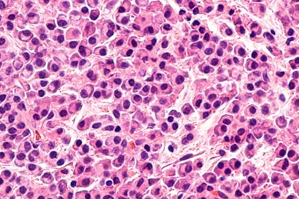 Multiple Myeloma