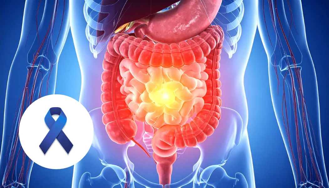 Colorectal Cancer