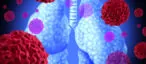 SCLC vs NSCLC
